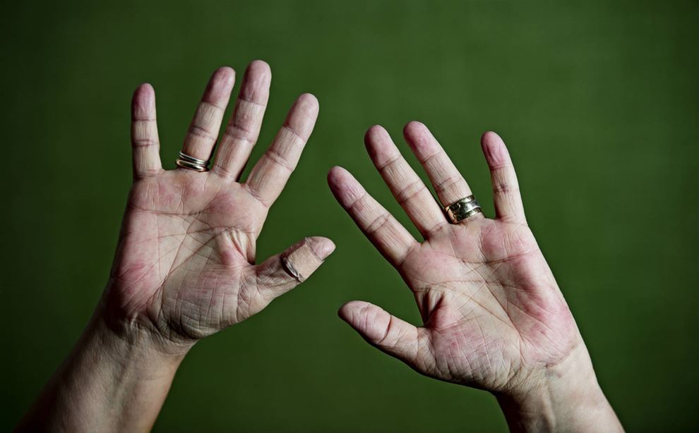 mavepine hjælp Overbevisende Hver femte sosu plages af håndeksem | Fagbladet FOA